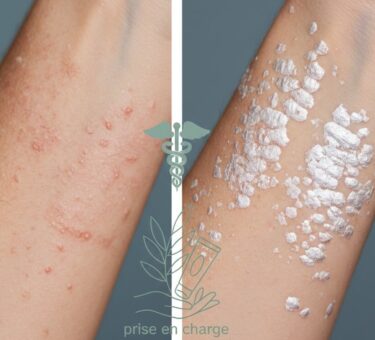 Eczéma et psoriasis : différences et prise en charge