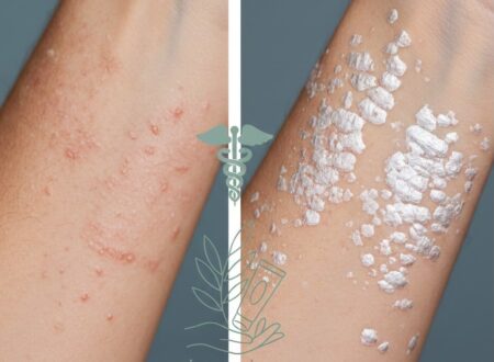 Eczéma et psoriasis : différences et prise en charge